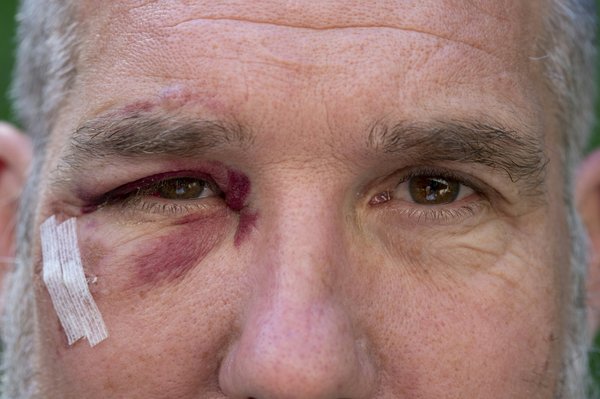 Traumatisme oculaire : comment faire face ?